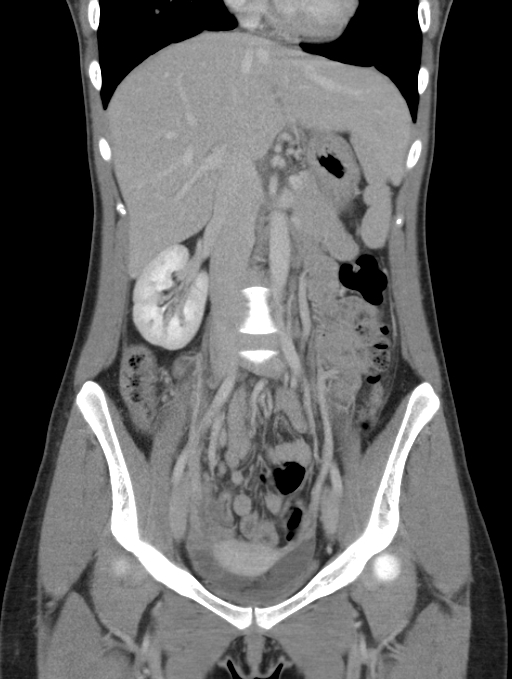 Acute appendicitis (Radiopaedia 62608-70901 Coronal C+ portal venous phase 20).jpg