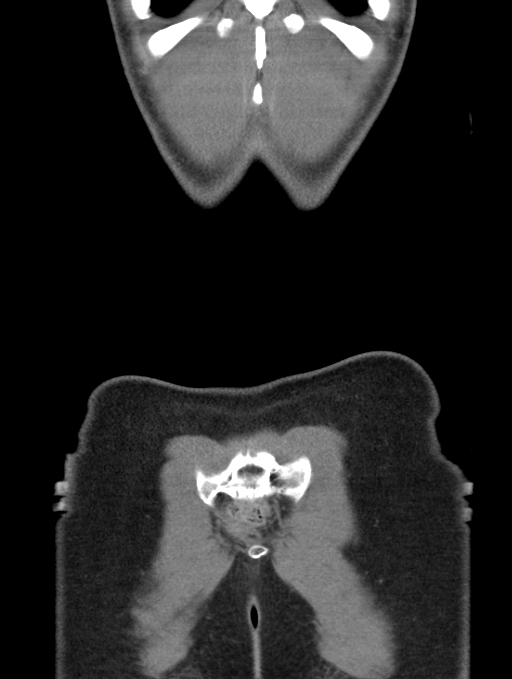 Acute appendicitis (Radiopaedia 62608-70901 Coronal C+ portal venous phase 62).jpg