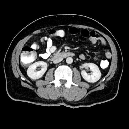 Acute appendicitis (Radiopaedia 77016-88960 Axial C+ portal venous phase 67).jpg