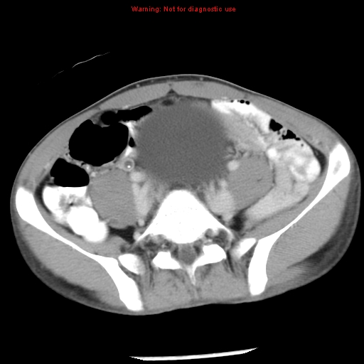 Acute appendicitis (Radiopaedia 8195-9045 Axial C+ portal venous phase 52).jpg