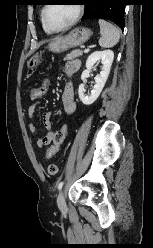 Acute appendicitis - large appendicoliths (Radiopaedia 61805-69820 Sagittal C+ portal venous phase 36).jpg
