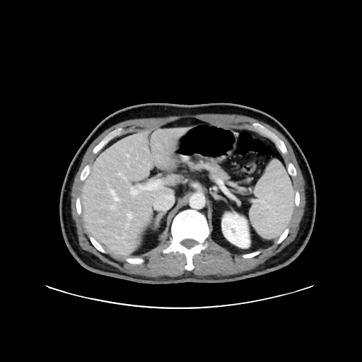 Acute appendicitis and COVID 19 pneumonia (Radiopaedia 76604-88380 Axial C+ portal venous phase 22).jpg