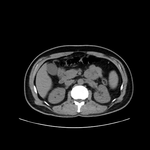 Acute appendicitis and COVID 19 pneumonia (Radiopaedia 76604-88380 Axial non-contrast 66).jpg