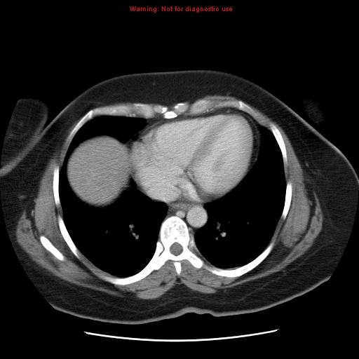 Acute appendicitis complicated by ovarian vein thrombophlebitis (Radiopaedia 16172-15851 Axial C+ portal venous phase 10).jpg