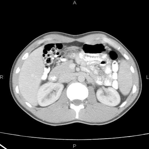 File:Acute appendicitis with CT arrowhead sign (Radiopaedia 21474-21411 Axial C+ portal venous phase 13).jpg