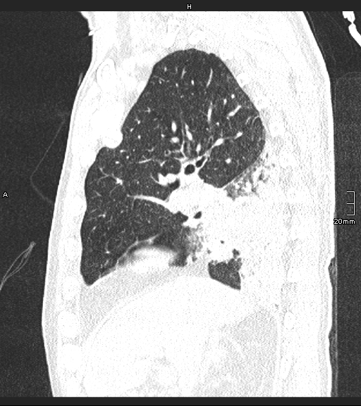 File:Acute aspiration pneumonitis (Radiopaedia 55642-62166 Sagittal lung window 100).jpg