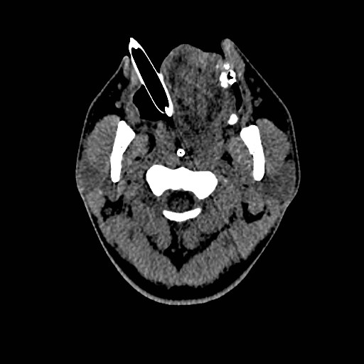 Acute basilar artery occlusion (Radiopaedia 43582-46985 Axial non-contrast 5).jpg