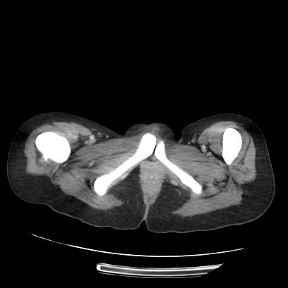 Acute calculous cholecystitis in patient with osteopetrosis (Radiopaedia 77871-90159 Axial C+ portal venous phase 84).jpg