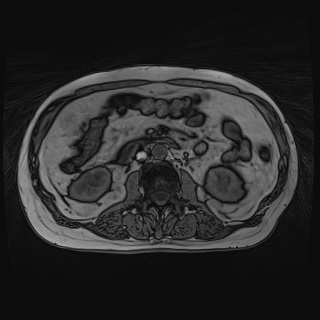 File:Acute cholecystitis (Radiopaedia 72392-82923 Axial T1 out-of-phase 73).jpg