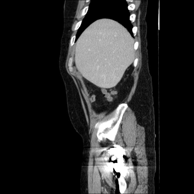 Acute cholecystitis and incidental left sided IVC (Radiopaedia 49352-54459 Sagittal C+ portal venous phase 75).jpg