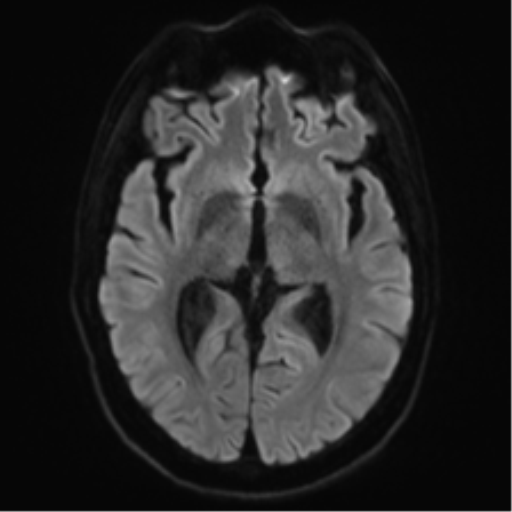 File:Acute disseminated encephalomyelitis (ADEM) (Radiopaedia 65319-74350 Axial DWI 14).png
