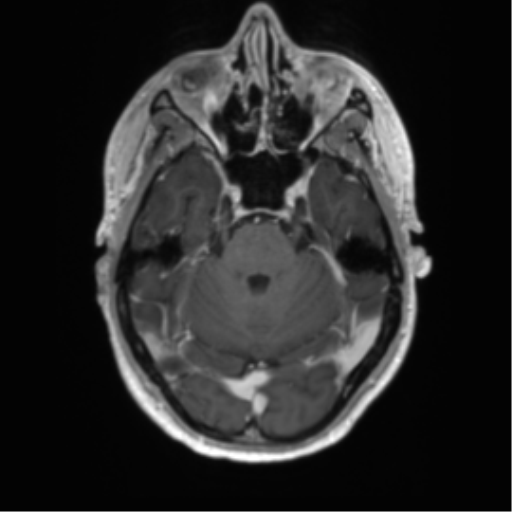 Acute disseminated encephalomyelitis (ADEM) (Radiopaedia 65319-74350 Axial T1 C+ 14).png