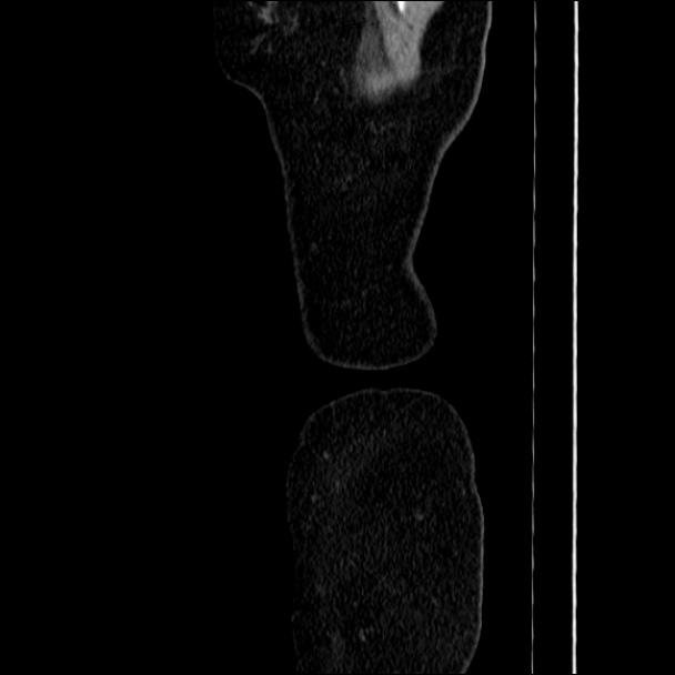 Acute diverticulitis (Radiopaedia 34183-35442 Sagittal C+ portal venous phase 102).jpg