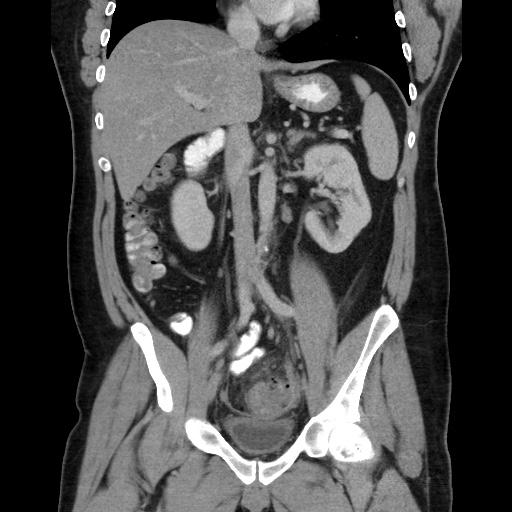 Acute diverticulitis with localized perforation (Radiopaedia 41296-44113 Coronal C+ portal venous phase 34).jpg