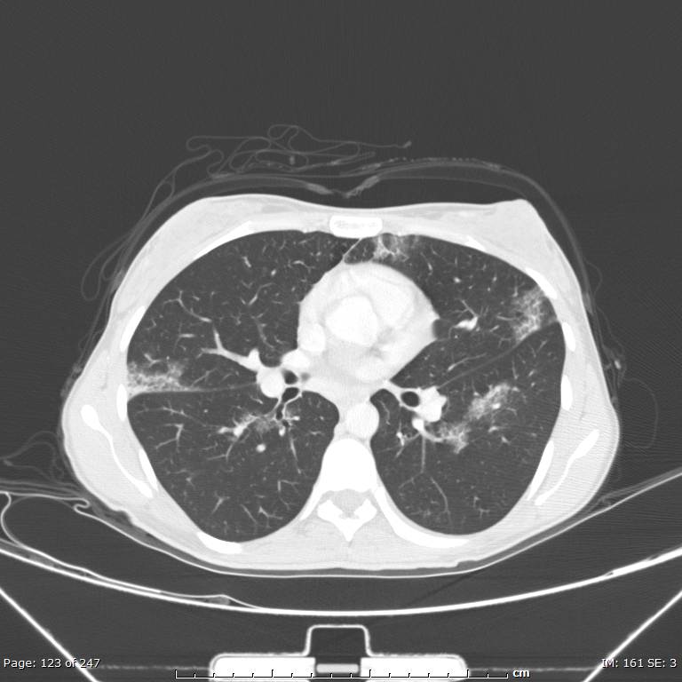 Acute eosinophilic pneumonia (Radiopaedia 48211-53073 Axial lung window 44).jpg