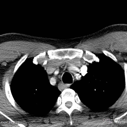 Acute epiglottitis (Radiopaedia 54375-60590 Axial C+ arterial phase 68).jpg