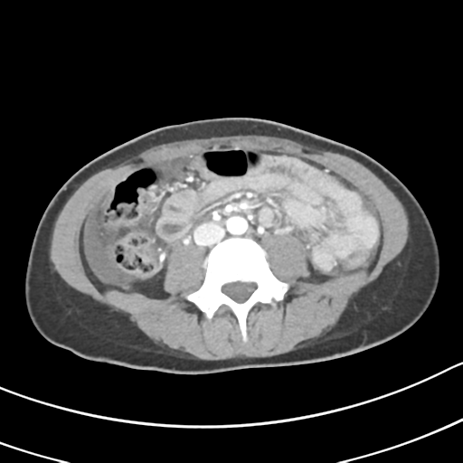 Acute gangrenous appendicitis with perforation (Radiopaedia 40152-42662 Axial C+ portal venous phase 38).png