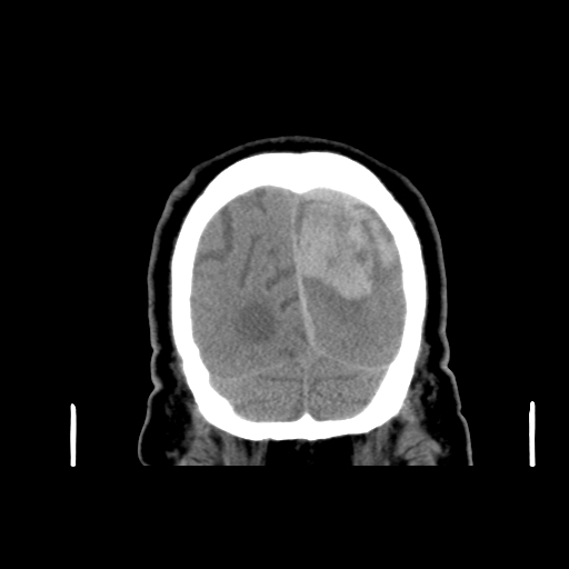 Acute hemorrhagic stroke (Radiopaedia 17507-17223 Coronal non-contrast 50).jpg
