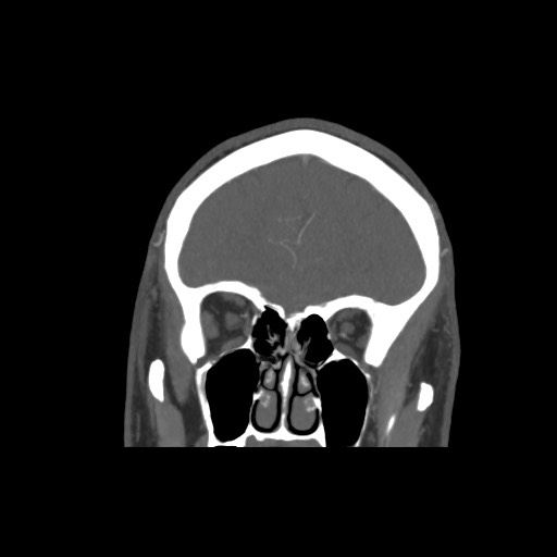 Acute internal carotid artery dissection (Radiopaedia 53541-59630 E 16).jpg