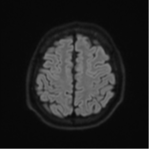 Acute left middle cerebral artery territory infarct with clot retrieval (Radiopaedia 47732-52433 Axial DWI 54).png