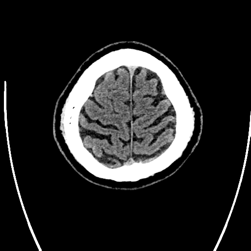 Acute left middle cerebral artery territory ischemic stroke (Radiopaedia 35688-37223 Axial non-contrast 76).png