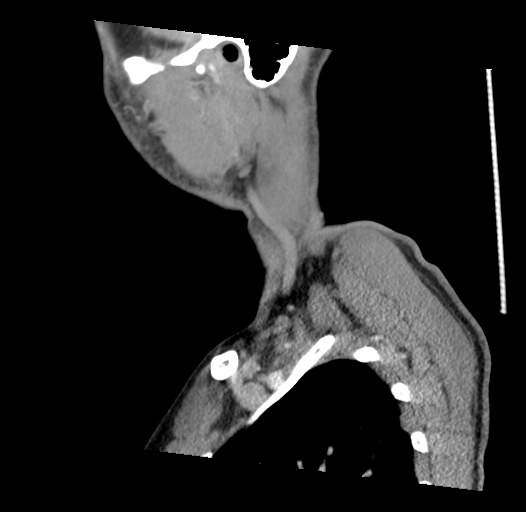 Acute longus colli calcific tendinitis (Radiopaedia 72495-83036 Sagittal C+ arterial phase 4).jpg