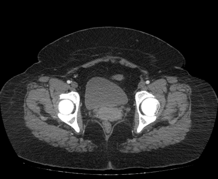 Acute mesenteric ischemia (Radiopaedia 80029-93316 Axial C+ arterial phase 126).jpg