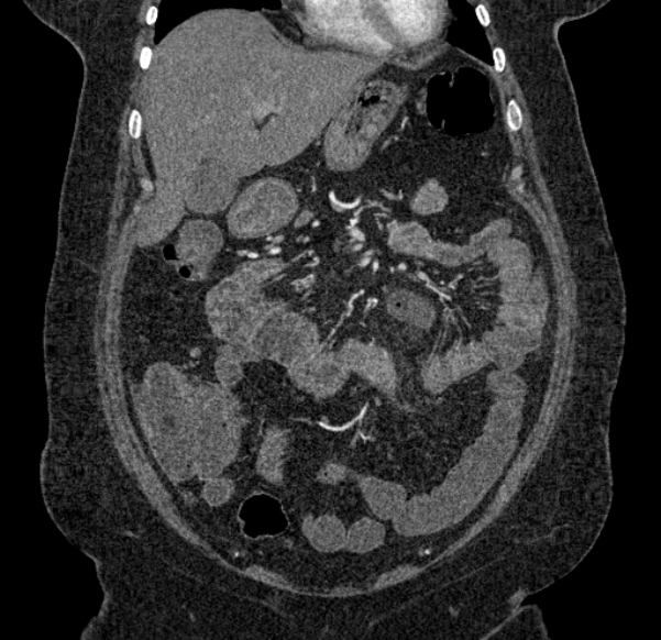 Acute mesenteric ischemia (Radiopaedia 80029-93316 Coronal C+ arterial phase 39).jpg