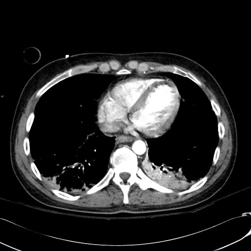 Acute myocardial infarction in CT (Radiopaedia 39947-42415 Axial C+ arterial phase 100).jpg