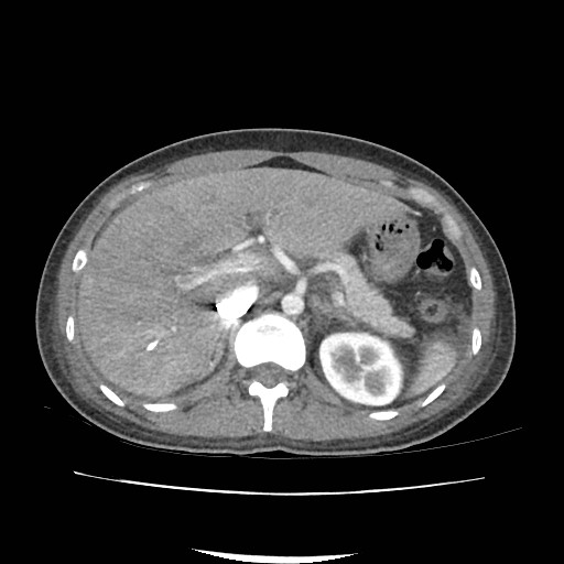 Acute myocarditis (Radiopaedia 55988-62613 Axial C+ portal venous phase 22).jpg