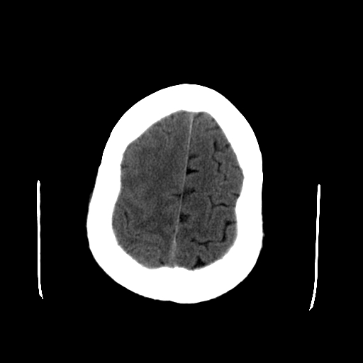 File:Acute necrotizing toxoplasma encephalitis (Radiopaedia 10683-11150 Axial non-contrast 8).jpg