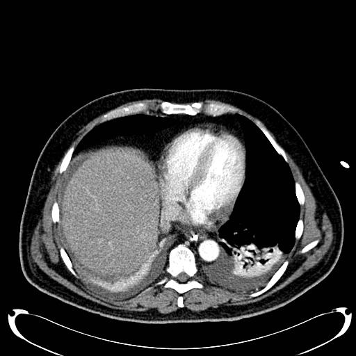 Acute pancreatic necrosis (Radiopaedia 13560-18500 Axial C+ portal venous phase 17).jpg
