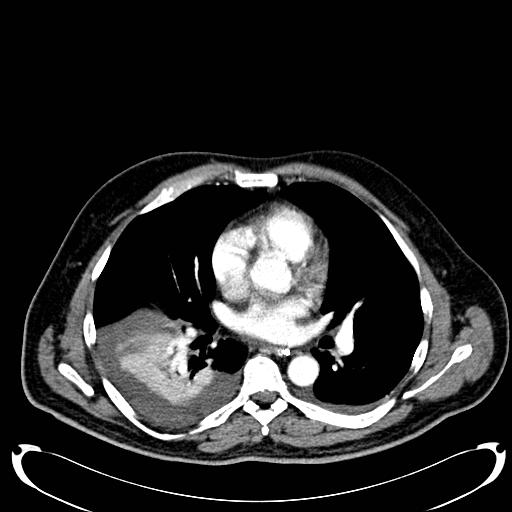 Acute pancreatic necrosis (Radiopaedia 13560-18500 Axial C+ portal venous phase 2).jpg