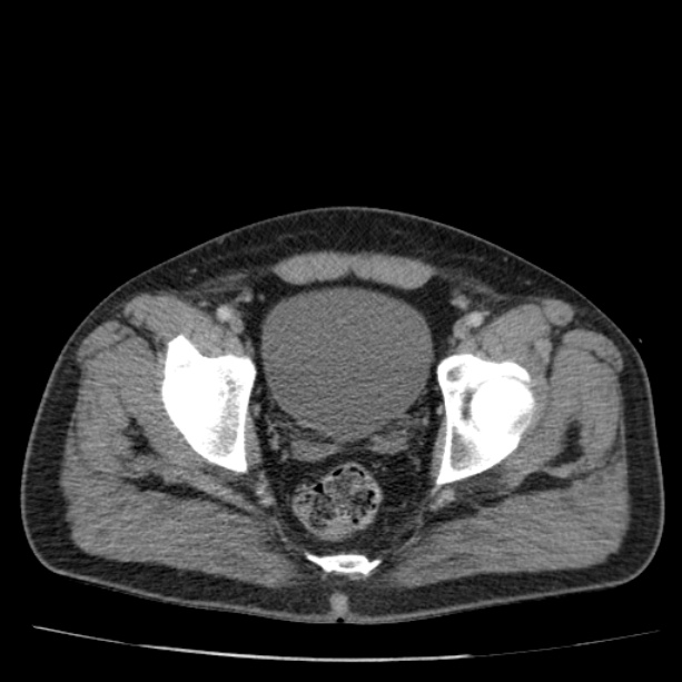 Acute pancreatitis (Radiopaedia 26663-26813 Axial C+ portal venous phase 80).jpg