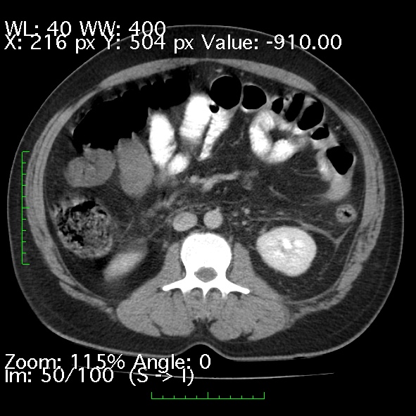 File:Acute pancreatitis (Radiopaedia 34043-35276 Axial C+ portal venous phase 50).jpg