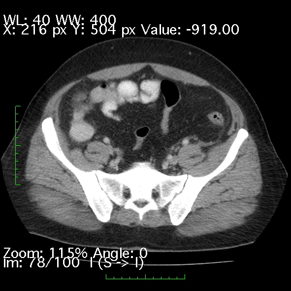 Acute pancreatitis (Radiopaedia 34043-35276 Axial C+ portal venous phase 78).jpg