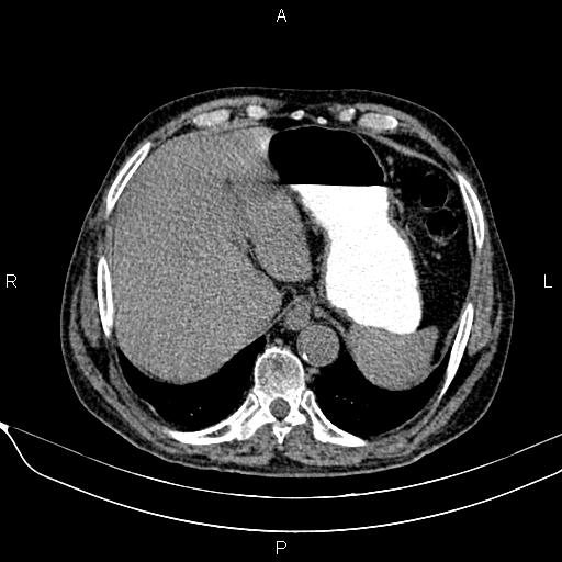File:Acute pancreatitis (Radiopaedia 85146-100701 Axial non-contrast 24).jpg