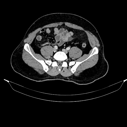 Acute pancreatitis (Radiopaedia 87428-103757 Axial C+ portal venous phase 71).jpg