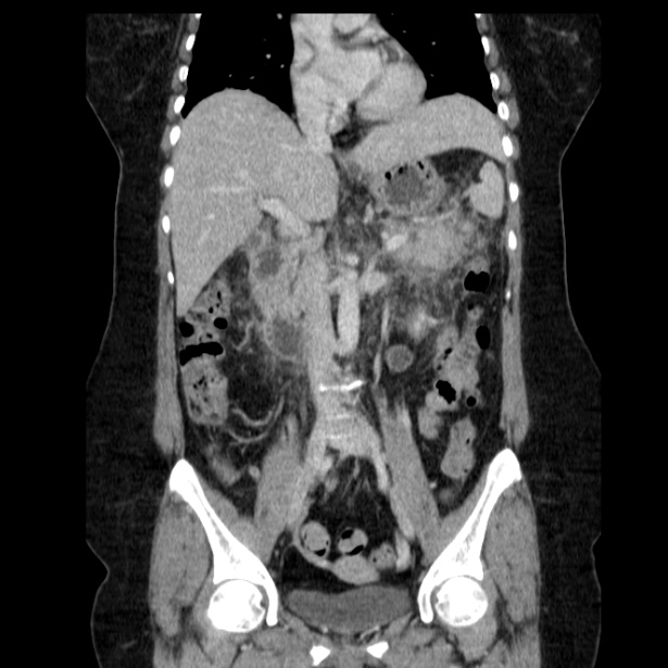 Acute pancreatitis - Balthazar C (Radiopaedia 26569-26714 Coronal C+ portal venous phase 35).jpg