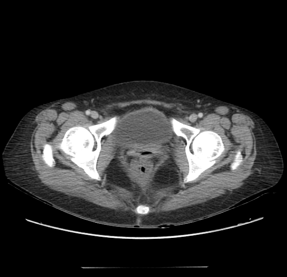 File:Acute pancreatitis - Balthazar E - post ERCP (Radiopaedia 27562-27772 Axial C+ portal venous phase 74).png