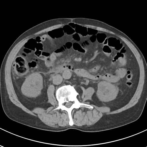 File:Acute pancreatitis and walled-off necrosis (Radiopaedia 29888-30404 Axial non-contrast 41).jpg