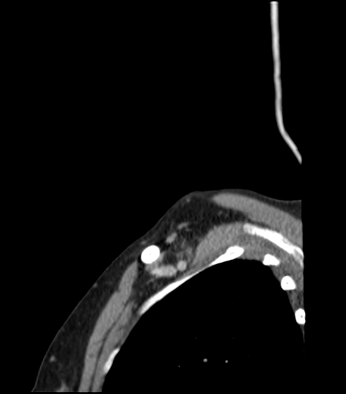 File:Acute parotitis (Radiopaedia 27425-27619 Sagittal C+ portal venous phase 1).png