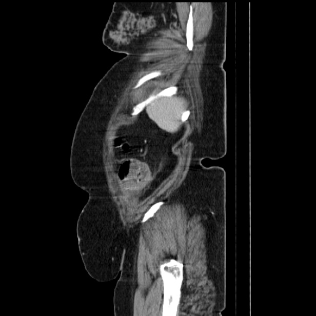 Acute pyelonephritis (Radiopaedia 25657-25837 Sagittal renal parenchymal phase 69).jpg