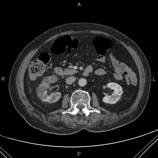 File:Acute renal artery occlusion (Radiopaedia 86586-102682 Axial C+ portal venous phase 36).jpg