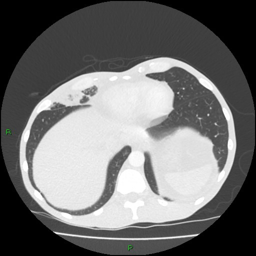 File:Acute right lung abscess (Radiopaedia 34806-36258 Axial lung window 157).jpg