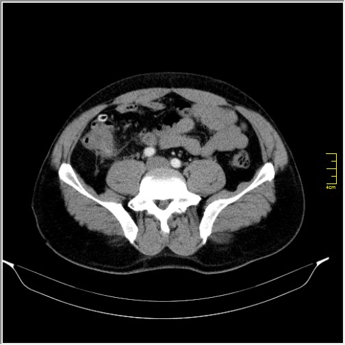 File:Acute right sided diverticulitis (Radiopaedia 65249-74268 Axial C+ portal venous phase 53).JPG