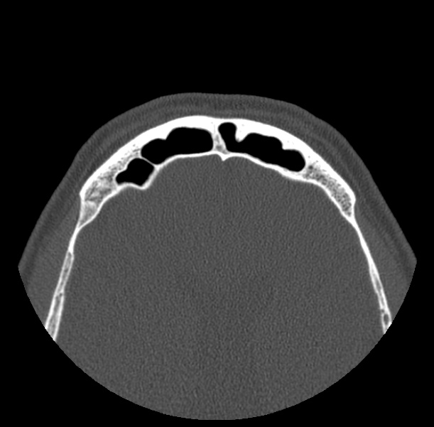 Acute sinusitis (Radiopaedia 23161-23215 Axial bone window 70).jpg
