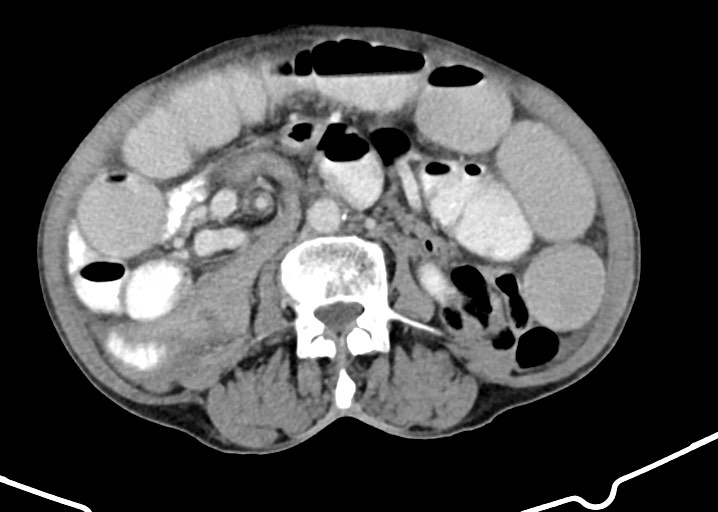 Acute small bowel (ileal) volvulus (Radiopaedia 71740-82139 Axial C+ portal venous phase 108).jpg