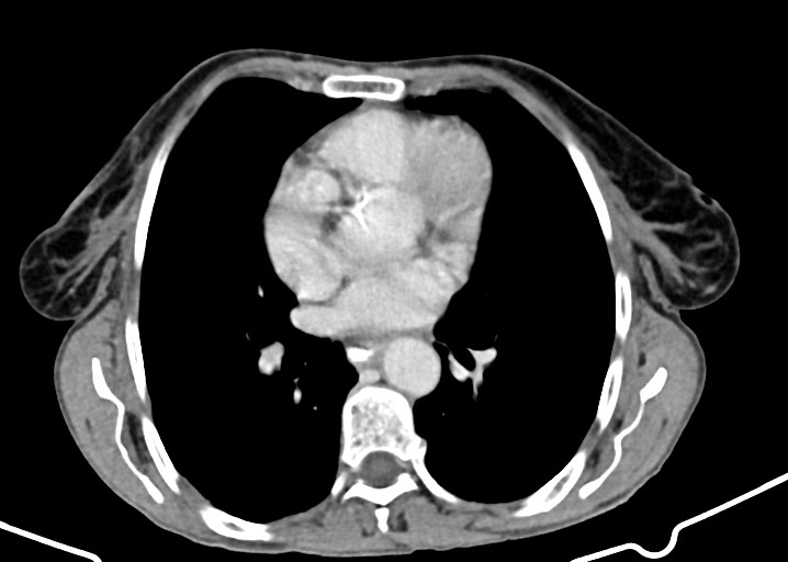 Acute small bowel (ileal) volvulus (Radiopaedia 71740-82139 Axial C+ portal venous phase 17).jpg