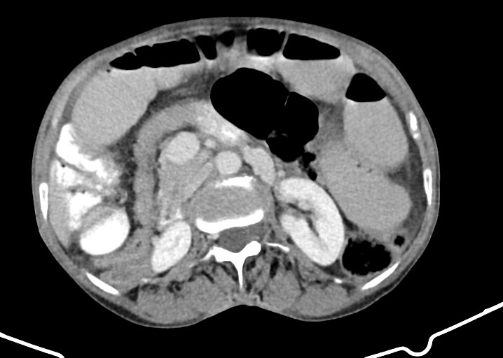 Acute small bowel (ileal) volvulus (Radiopaedia 71740-82139 Axial C+ portal venous phase 88).jpg
